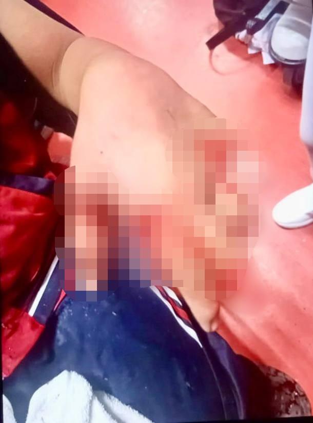 ¡Lamentable! Adolescente pierde dedos al explotarle pirotecnia; ocurrió en Pachuca